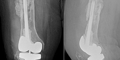Фаготерапия MRSA-инфекции суставного протеза